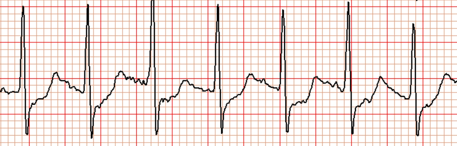 Registro ECG de prueba de esfuerzo con descenso limítrofe del segmento ST