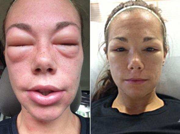 ejercicio-y-alergia-248